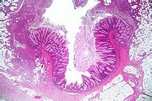 diverticulosis wikipedia